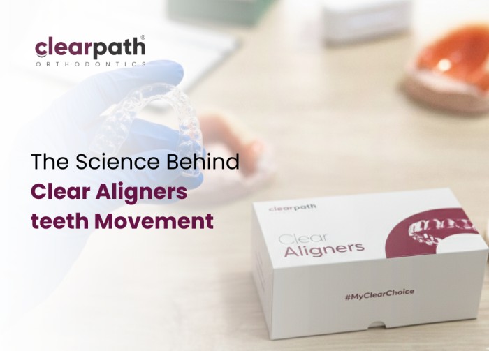 How Clear Aligners Move Your Teeth